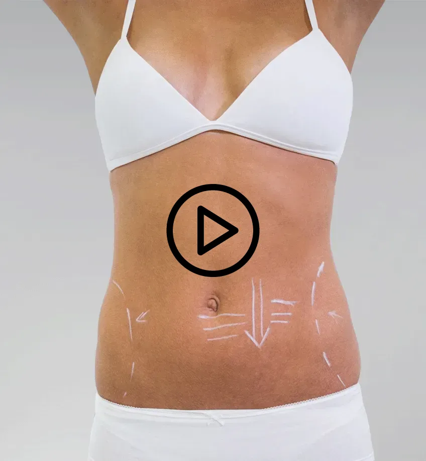 mommy makeover in Colombia with abdominoplasty