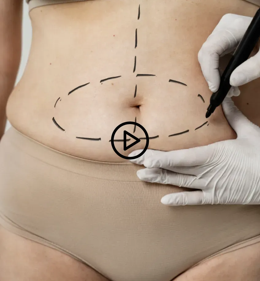 Benefits of Tummy Tuck in Colombia