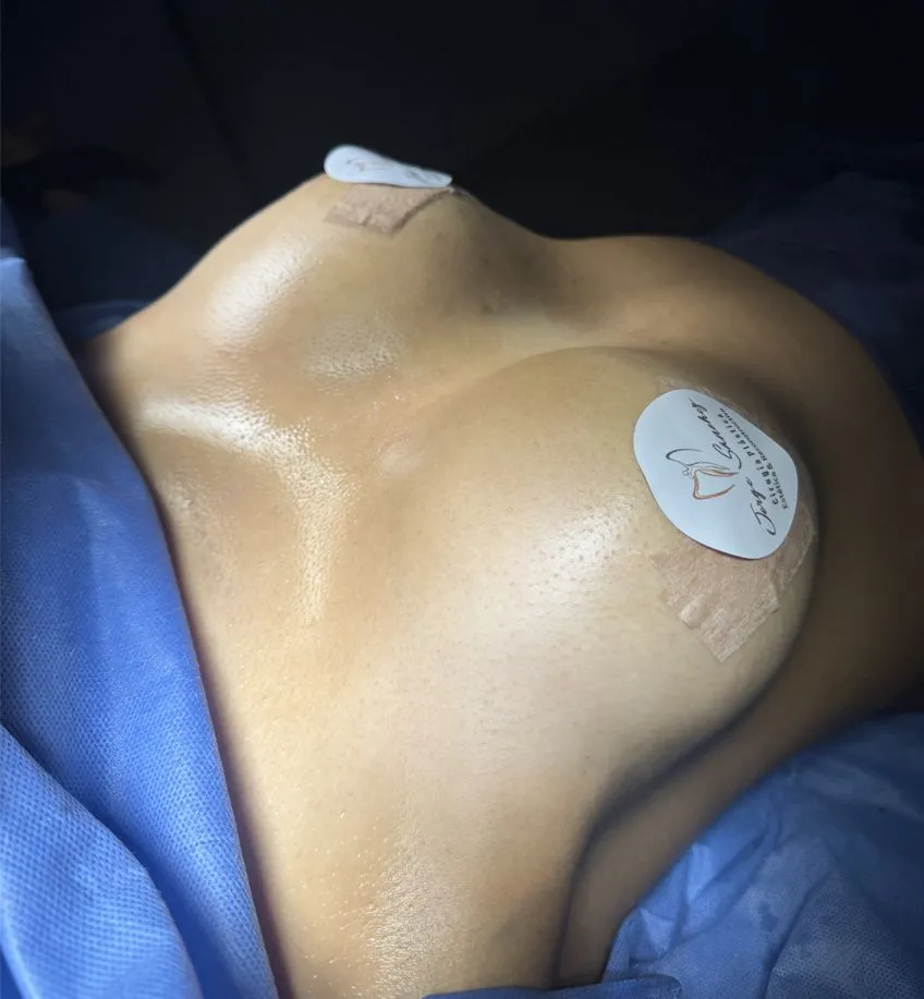 Patient after breast augmentation in Colombia